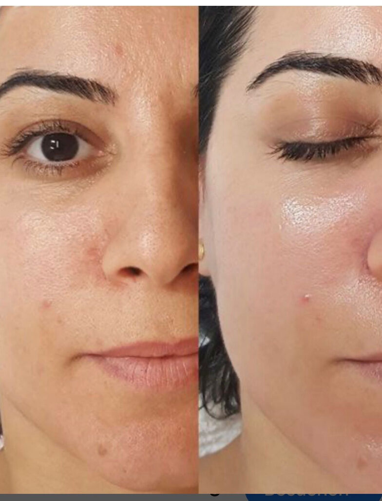 Fruchtsäure-Peeling Vaterstetten – klareres Hautbild